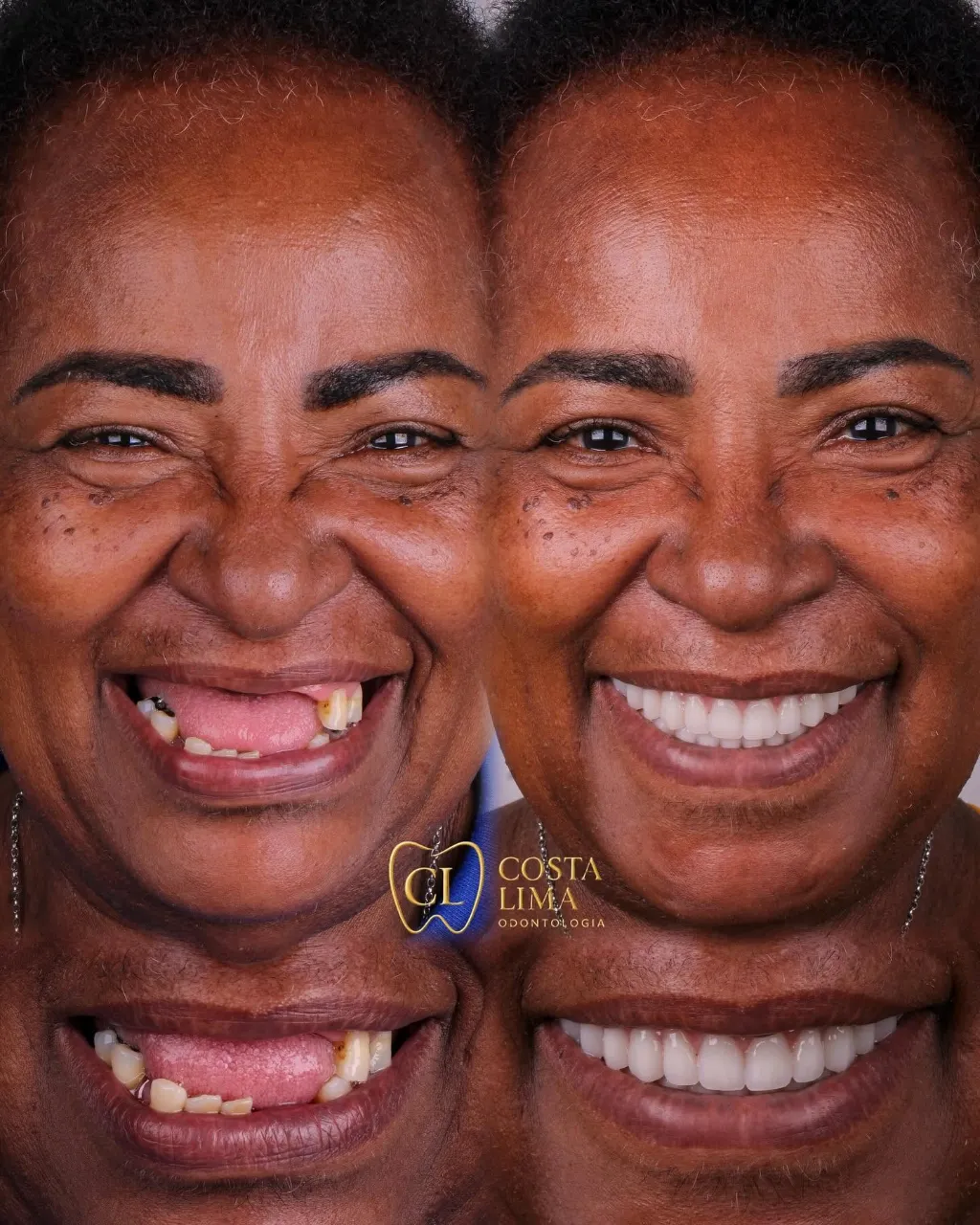 Implante dentário em Madureira na Costa Lima Odontologia